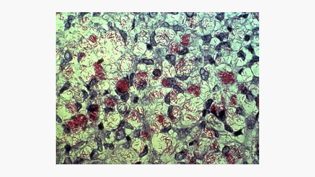 Mycobacterium leprae (zobrazeno pomocí Zeihl-Neelsenova barvení)