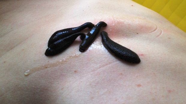 Pijavice se přisaje k tělu téměř okamžitě. Pocity jsou podobné jako u kousnutí komára