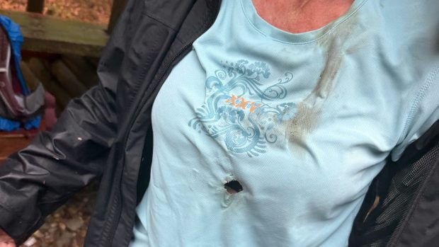 Známky zásahu bleskem na těle zraněné turistky