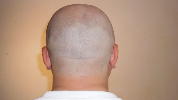 800px-bald_mans_nape_170609-115739_per.jpg