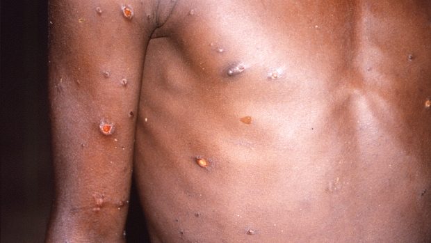 Ruka a trup pacienta s mpox během epidemie, která se vyskytla v Demokratické republice Kongo v letech 1996 až 1997. Charakteristiká je vyrážka tvořená puchýři původně naplněnými tekutinou (archivní foto)