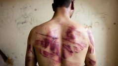 Syřan ukazuje stopy po mučení, které nese na zádech po propuštění z režimem spravovaného vězení (severní Aleppo, 23. srpna 2012).