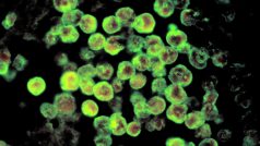 Histopatologie amébické meningoencefalitidy, kterou způsobuje parazit Naegleria fowleri