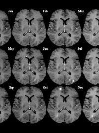 Snímky řezu mozku z magnetické rezonance v měsíčních intervalech. Světlé skvrny indikují aktivní poškození (léze)