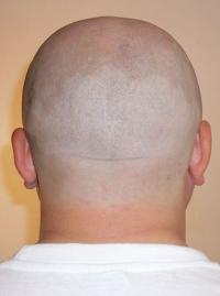 800px-bald_mans_nape_170609-115739_per.jpg
