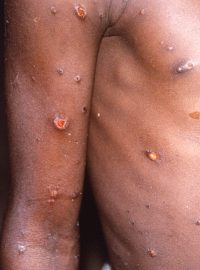 Ruka a trup pacienta s mpox během epidemie, která se vyskytla v Demokratické republice Kongo v letech 1996 až 1997. Charakteristiká je vyrážka tvořená puchýři původně naplněnými tekutinou (archivní foto)